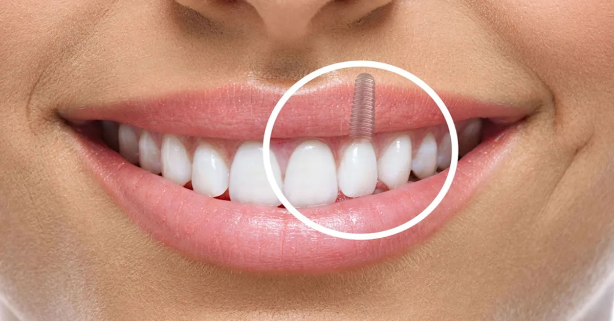 Dental Implants in the Long Term
