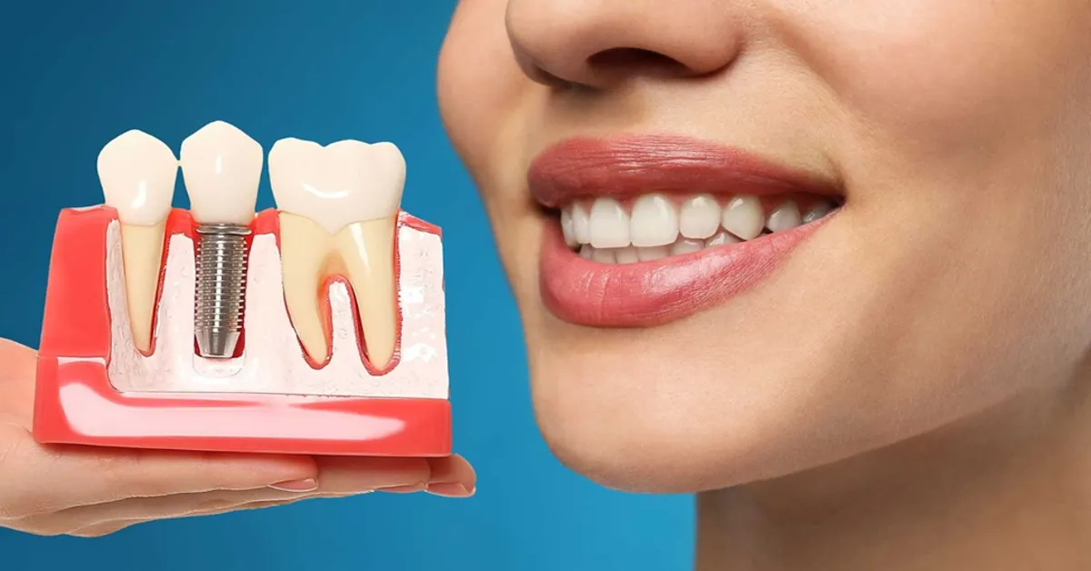 Candidate for Dental Implants