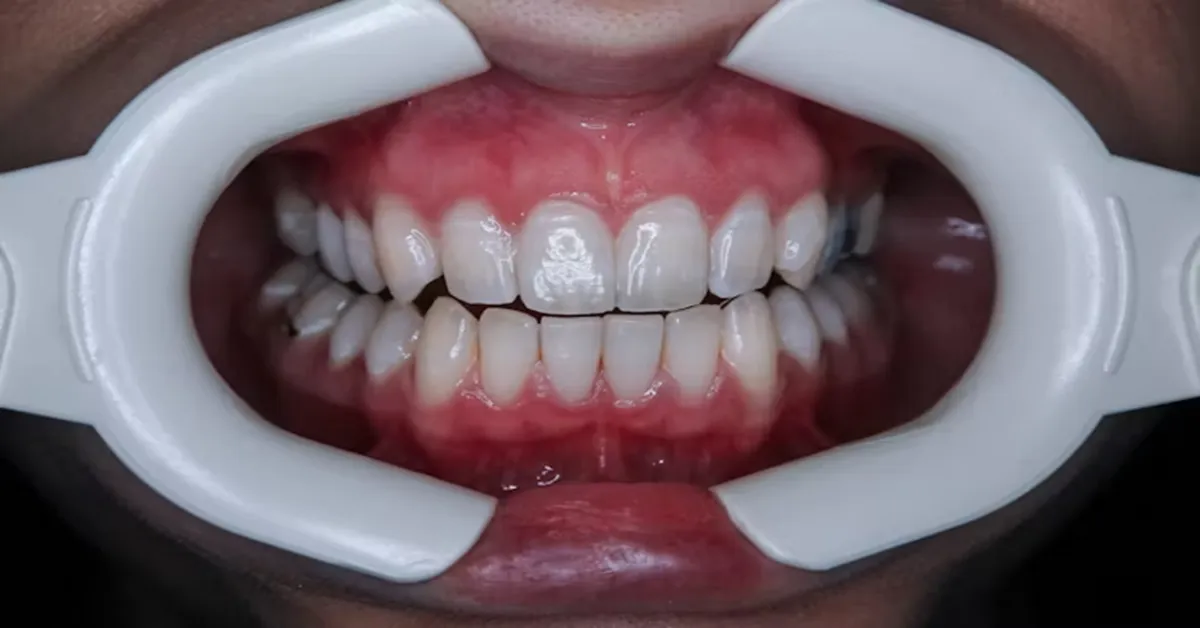 Tooth Replacement