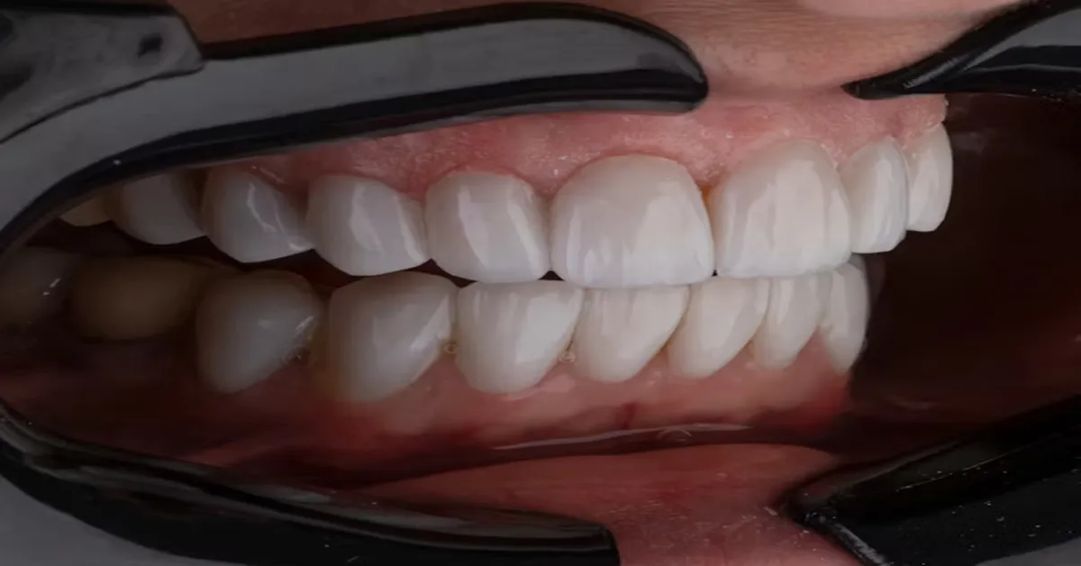 Restore Smiles