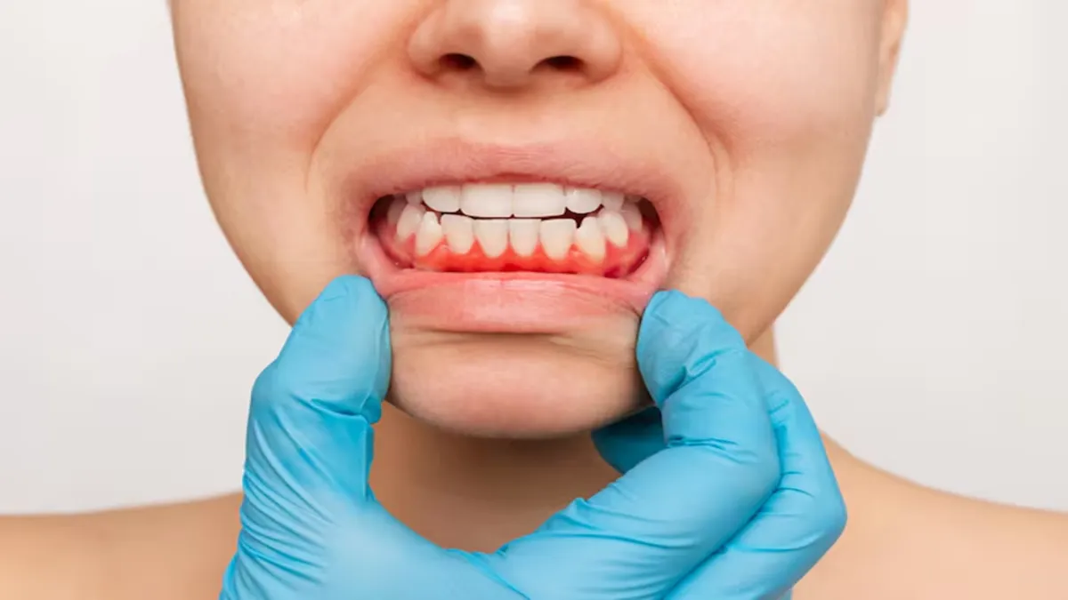 Gingival Recession Surgery
