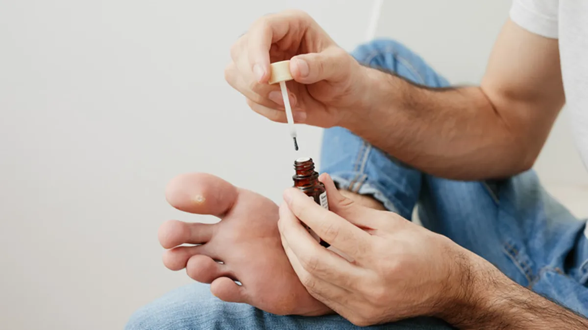 Warts Without Surgery